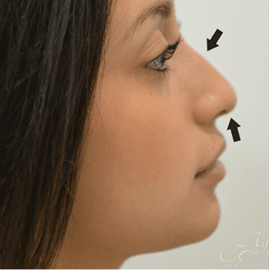 Rhinoplasty Case 2 – Before