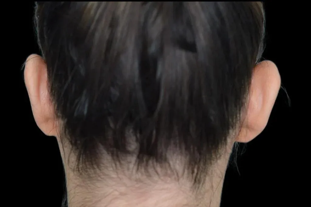 Ear Surgery Case 13 – Before