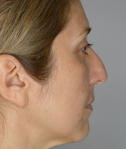 Rhinoplasty Case 35 – Before