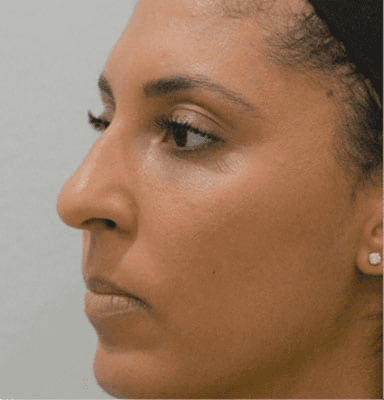Rhinoplasty Case 3 – Before