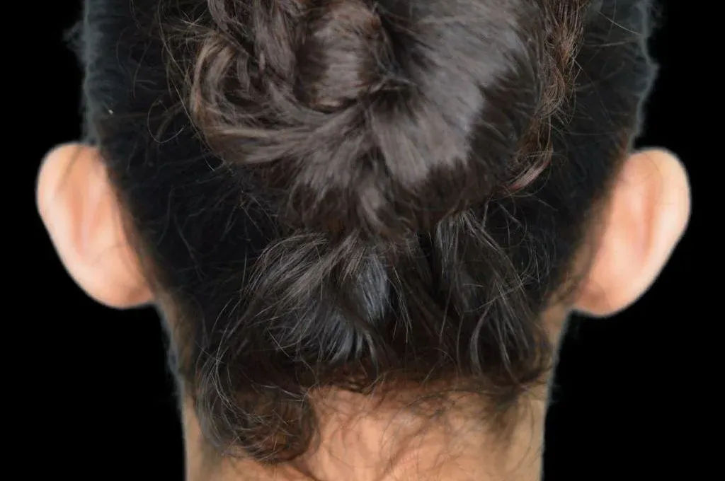 Ear Surgery Case 16 – Before