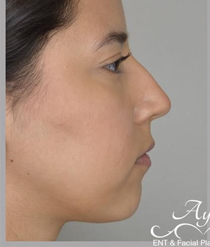 Rhinoplasty Case 36 – Before