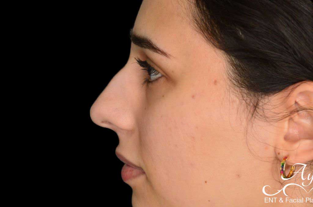 Rhinoplasty Case 41 – Before