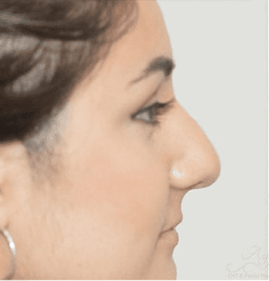 Rhinoplasty Case 8 – Before