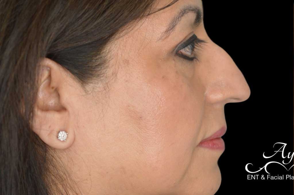 Rhinoplasty Case 42 – Before