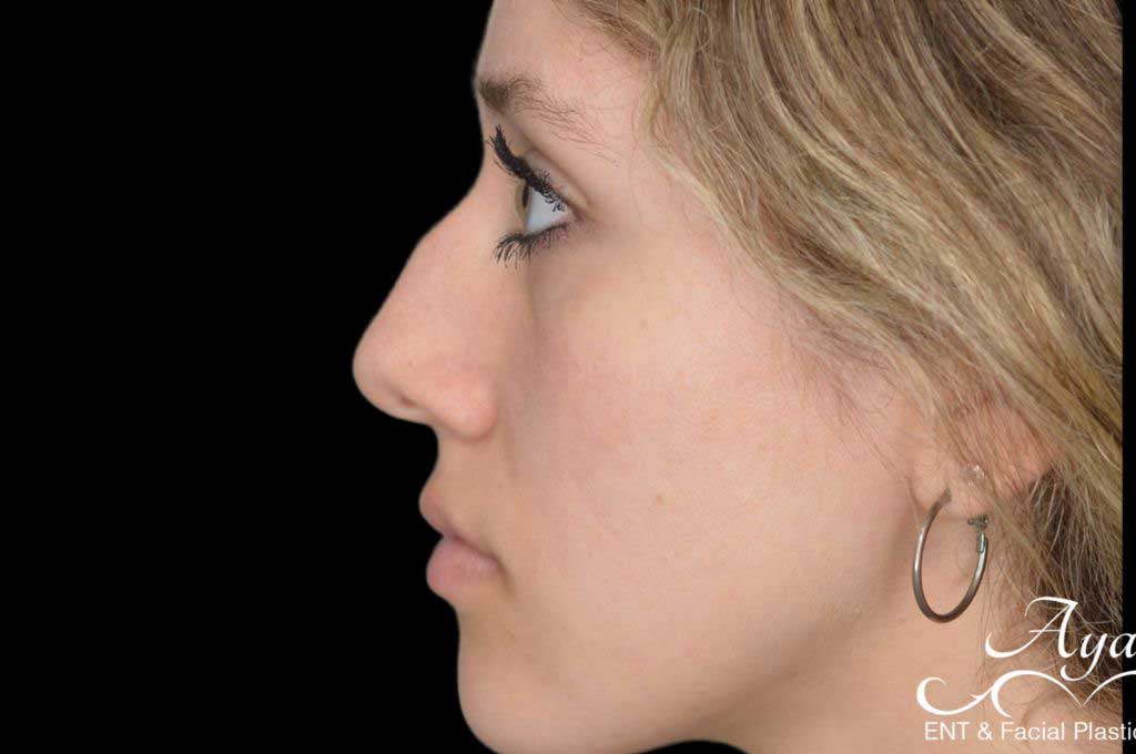 Rhinoplasty Case 43 – Before