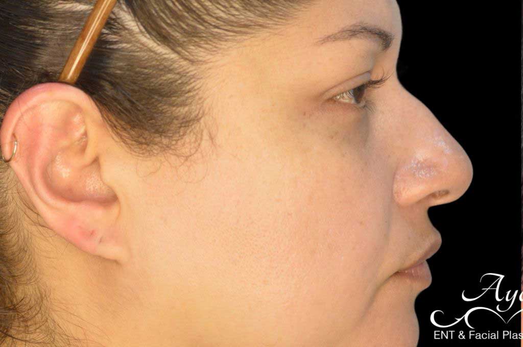 Rhinoplasty Case 44 – Before