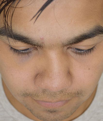 Rhinoplasty Case 25 – Before