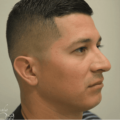 Rhinoplasty Case 10 – After