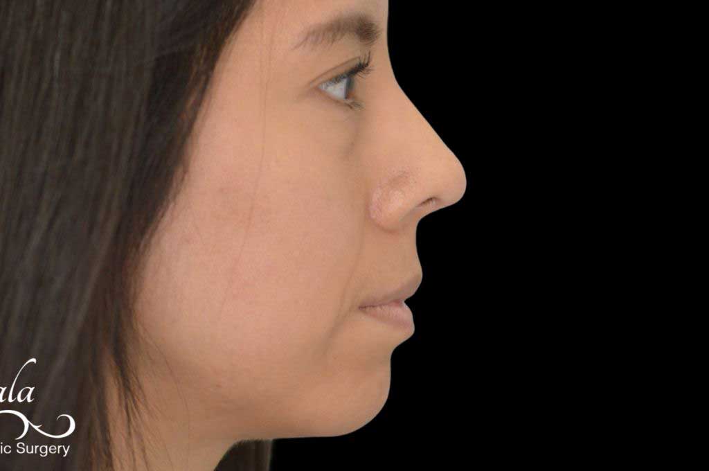 Rhinoplasty Case 45 – After