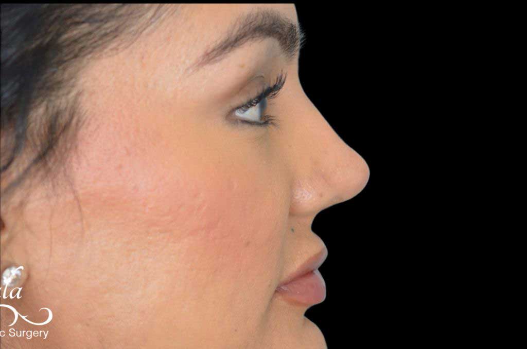 Rhinoplasty Case 46 – After