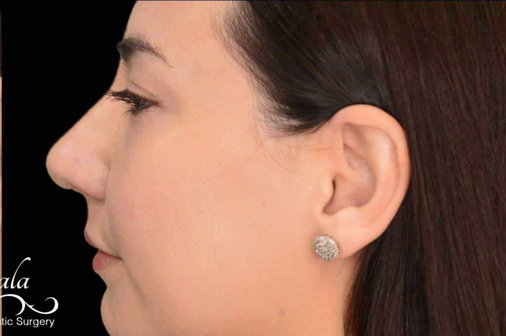 Rhinoplasty Case 47 – After