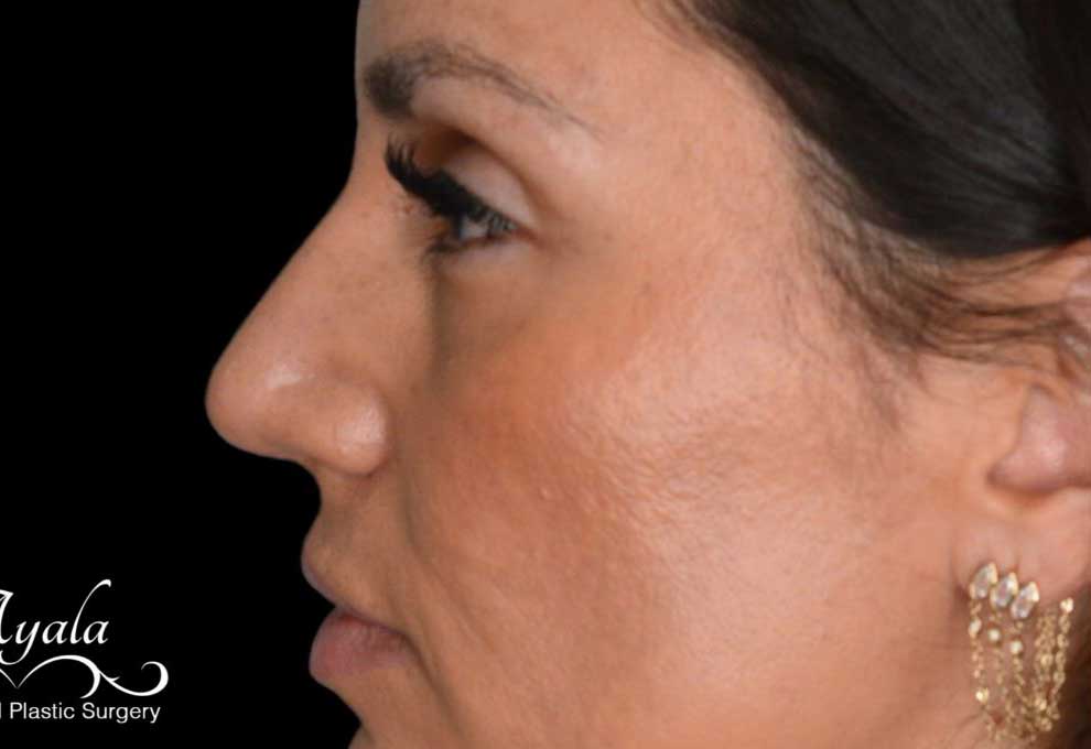 Rhinoplasty Case 48 – After