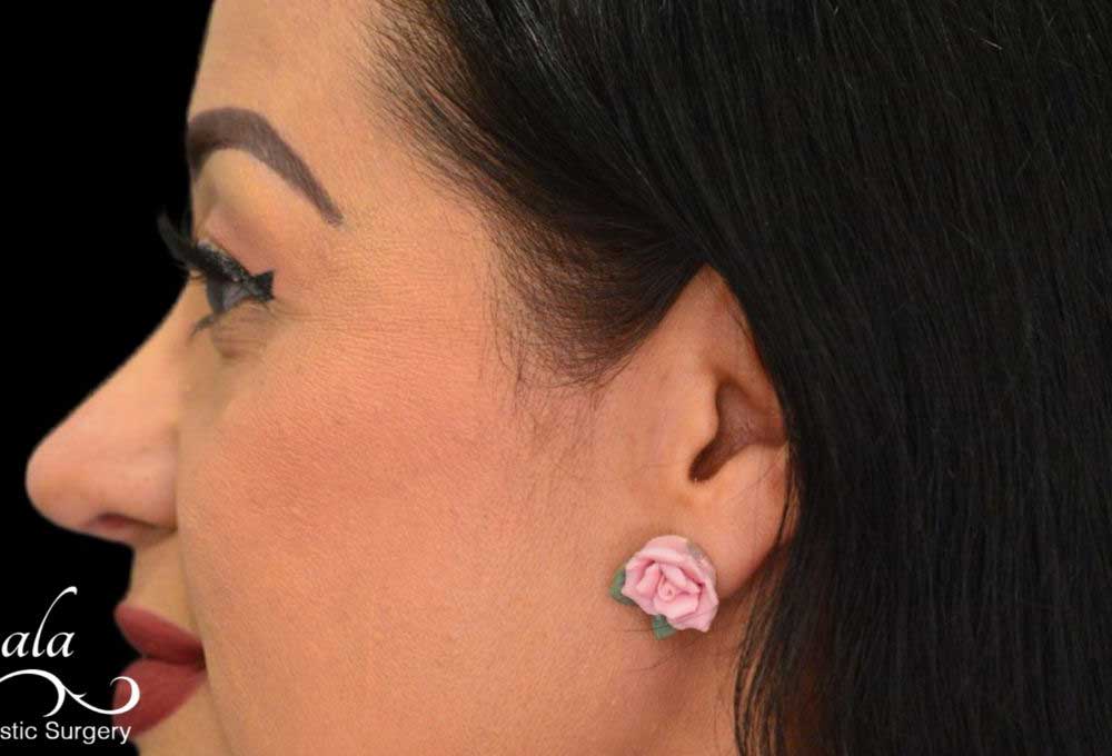Rhinoplasty Case 49 – After