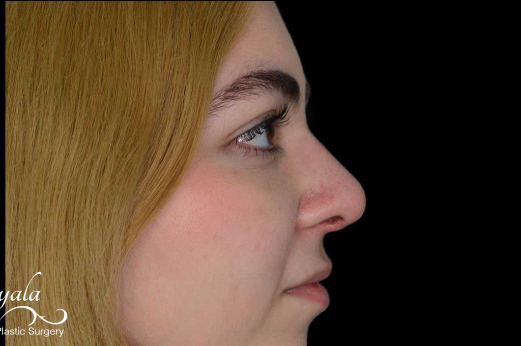 Rhinoplasty Case 50 – After