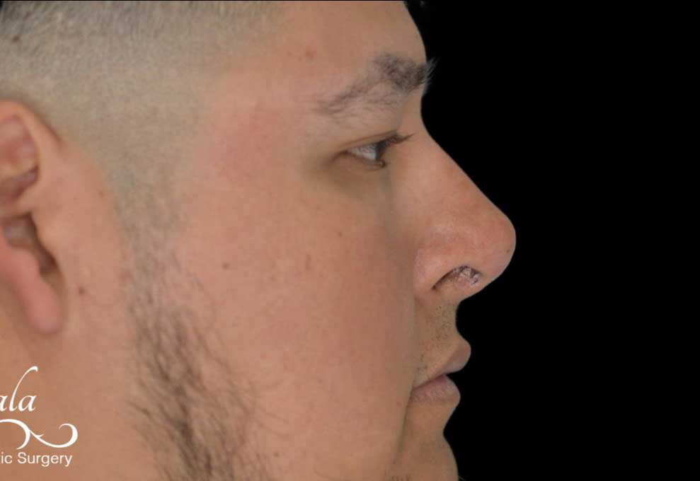 Rhinoplasty Case 51 – After