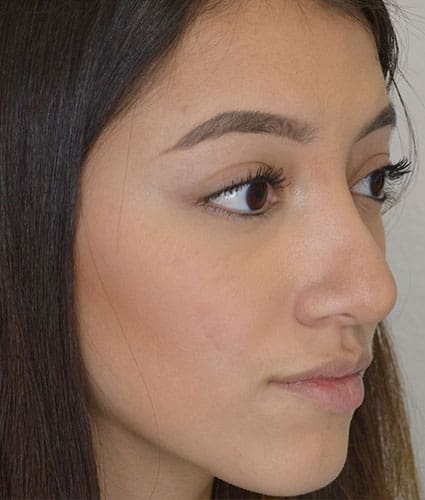 Rhinoplasty Case 27 – After