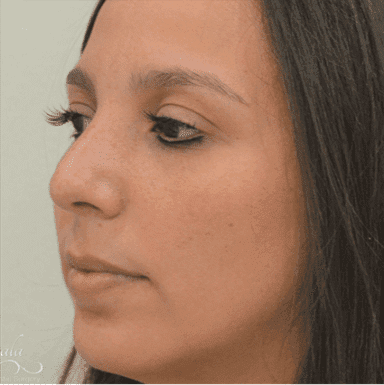 Rhinoplasty Case 15 – After
