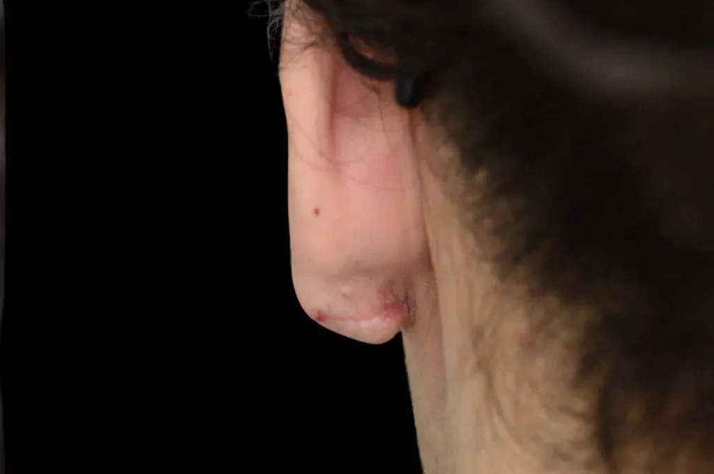 Ear Surgery Case 12 – After