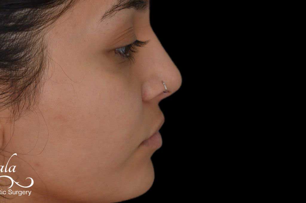 Rhinoplasty Case 55 – After