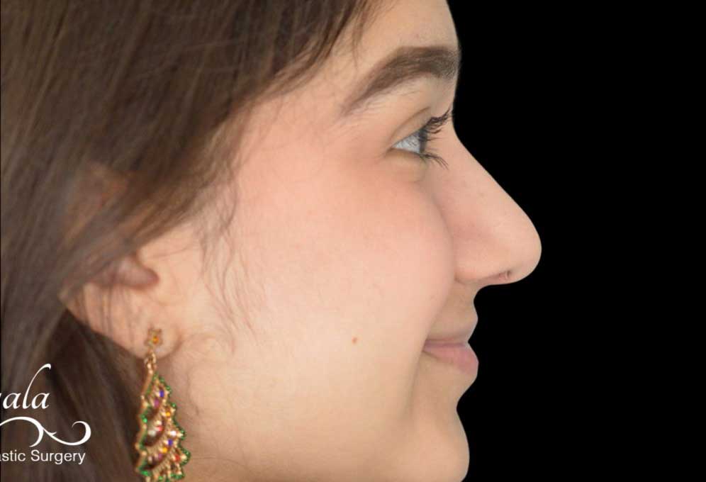 Rhinoplasty Case 56 – After