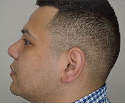 Ear Surgery Case 4 – After