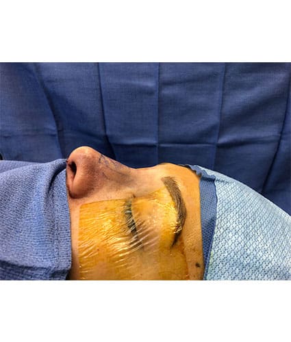 Rhinoplasty Case 28 – After