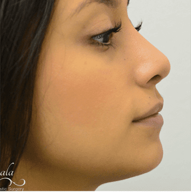 Rhinoplasty Case 2 – After