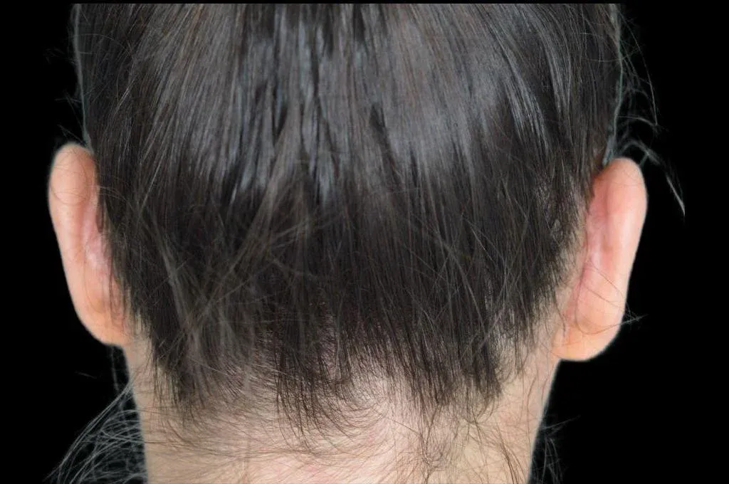Ear Surgery Case 13 – After