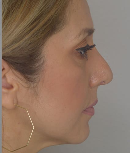 Rhinoplasty Case 35 – After