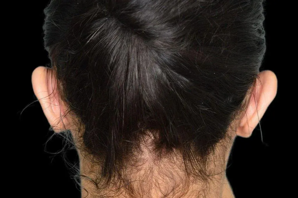 Ear Surgery Case 16 – After