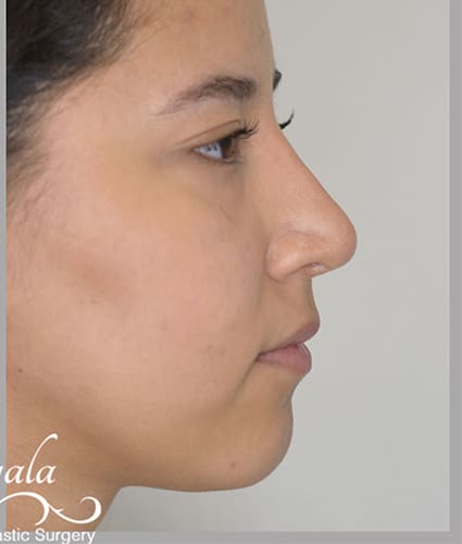 Rhinoplasty Case 36 – After