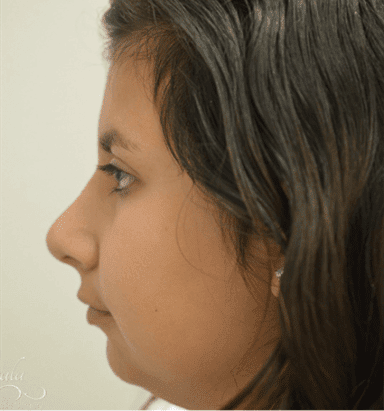 Rhinoplasty Case 7 – After