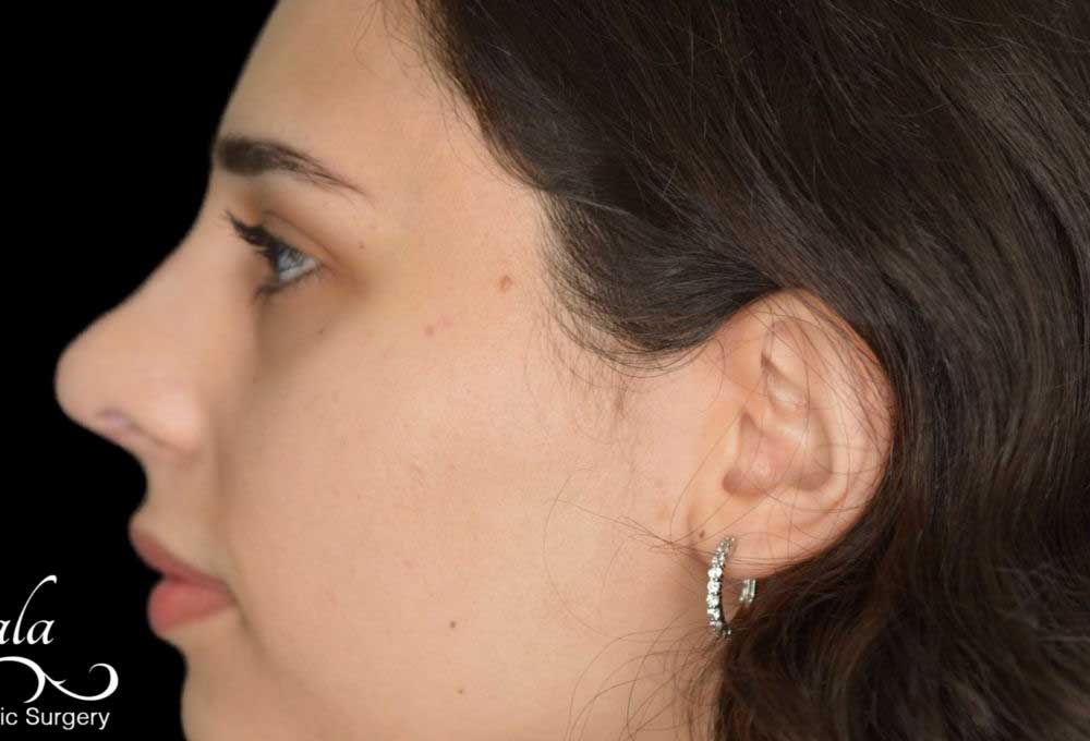 Rhinoplasty Case 41 – After