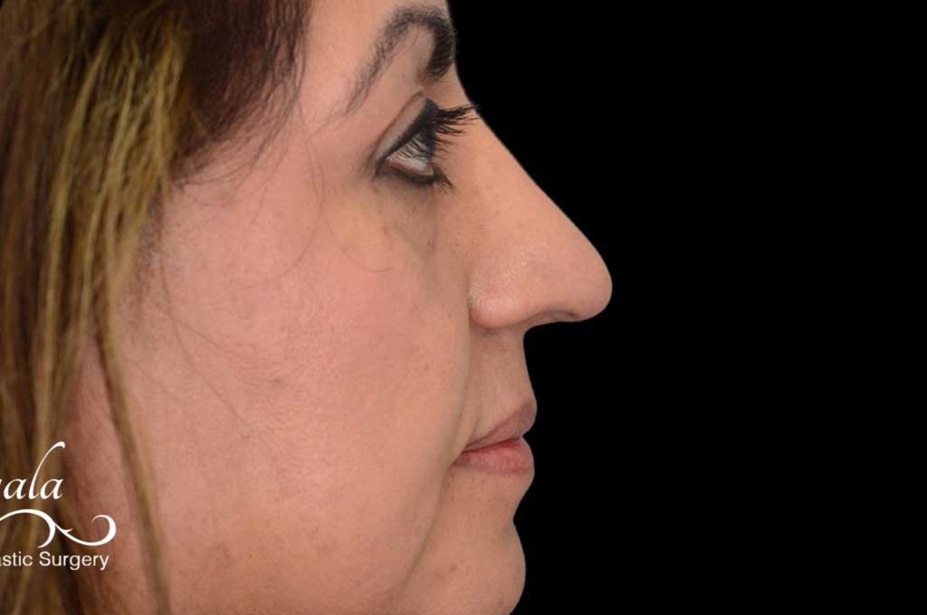 Rhinoplasty Case 42 – After