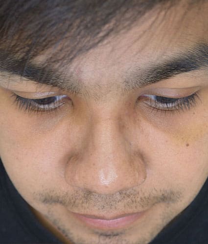 Rhinoplasty Case 25 – After