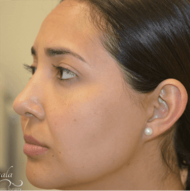 Rhinoplasty Case 1 – After