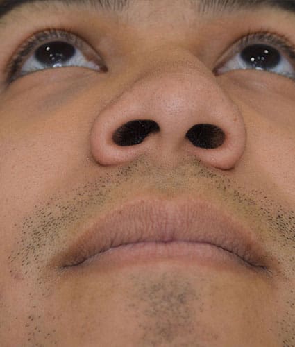 Rhinoplasty Case 25 – Before