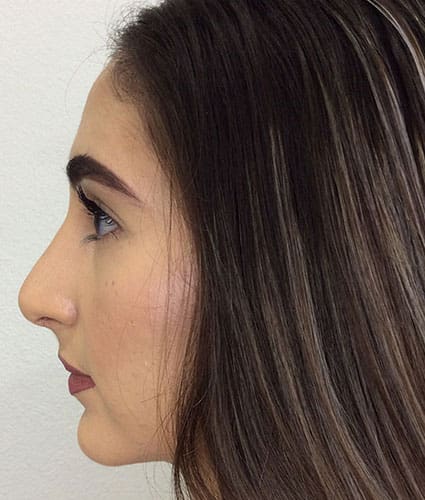 Rhinoplasty Case 26 – After