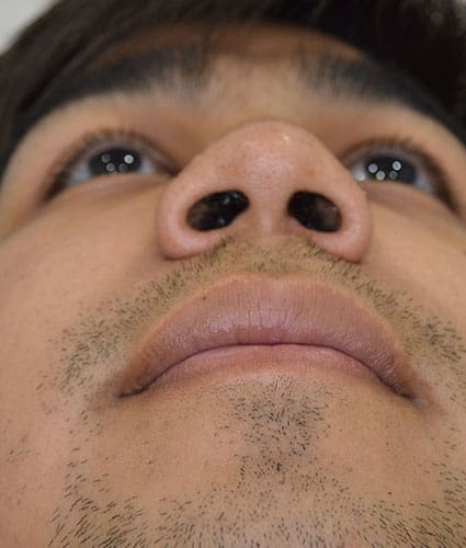 Rhinoplasty Case 25 – After
